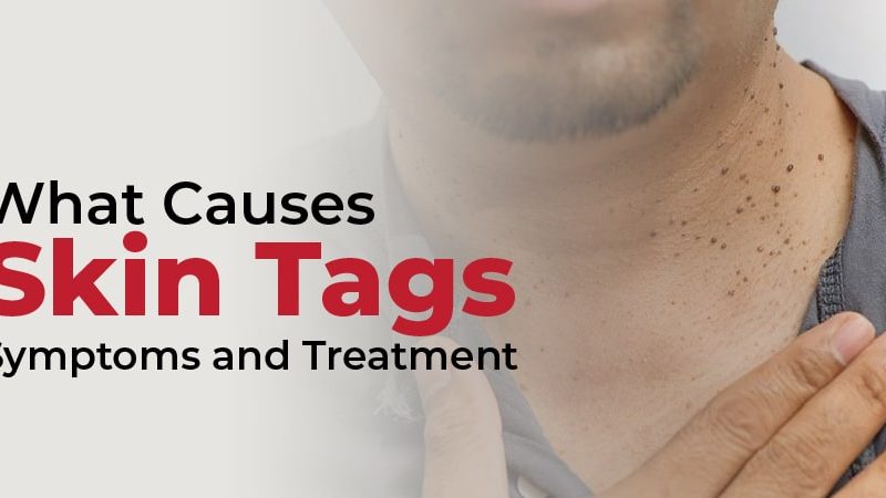 What Causes Skin Tags? Symptoms and Treatment
